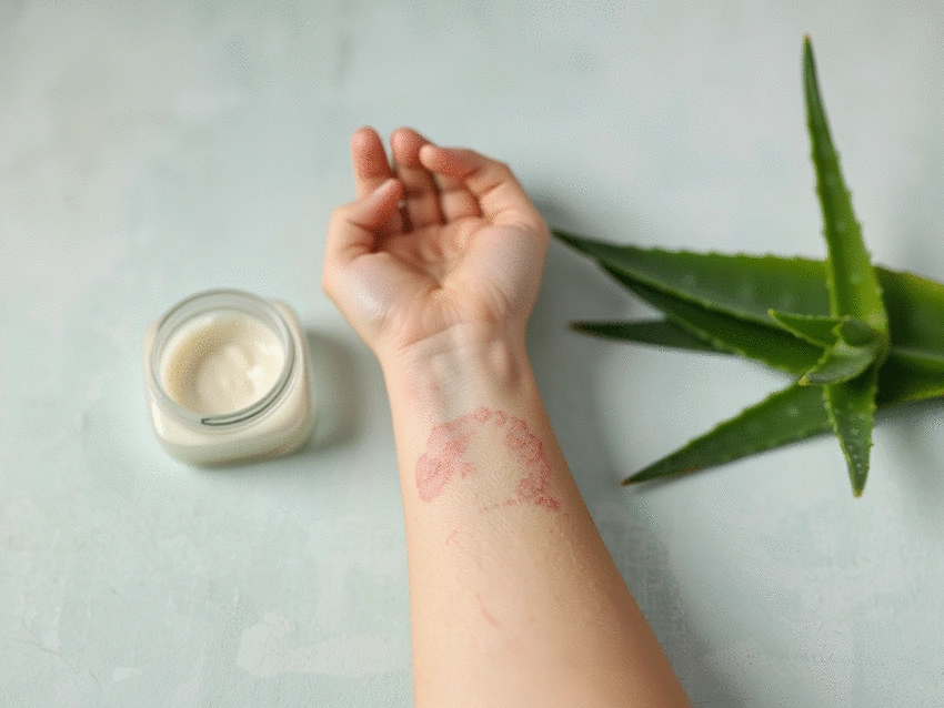 How to Identify and Treat Psoriasis: Causes, Symptoms, and Remedies