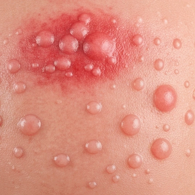 Close-up of skin with various types of rashes, representing different causes like allergies, infections, and irritants, on a neutral background, no text, no words, no typography, clean image